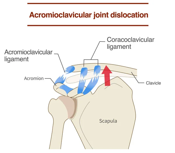 stock vector Dislocation of the acromioclavicular joint and ligaments and its mechanism