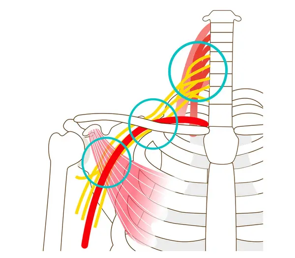 导致胸腔出口综合征的三个间隙 — 图库矢量图片