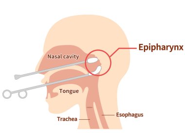 EpiPharyngeal Aşındırıcı Terapi nasıl gerçekleştirilir ve resmedilir; B-noktası therap