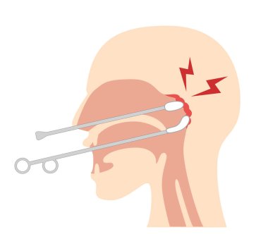 EpiPharyngeal Aşındırıcı Terapi nasıl gerçekleştirilir ve resmedilir; B-noktası therap