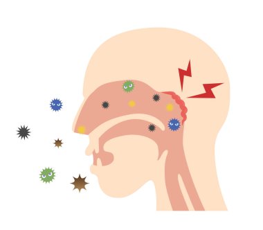 Kafanın, nazofarenksin bakterilerle iltihaplandığı yandan görünüşü.