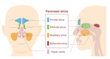 Illustrative illustrations of the anatomy of the paranasal sinuses from frontal and lateral sagittal plane views clipart