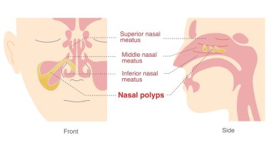 Illustration of nasal polyps in the sinuses from front and side views clipart