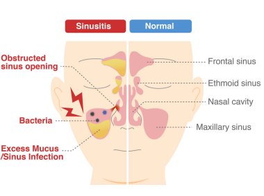 Comparative chart of how and why chronic sinusitis occurs clipart
