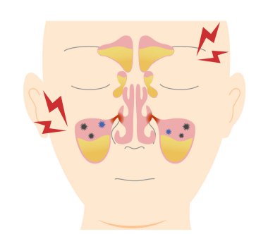 How and why chronic sinusitis occurs clipart