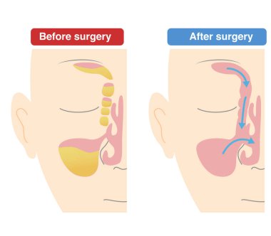 Comparative diagram of how Endoscopic Sinus Surgery;ESS is performed vs. preoperative clipart