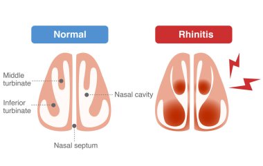 Rhinitis ve tıkalı burun sırasında alt meatus 'taki kan damarlarının genişlemesi.