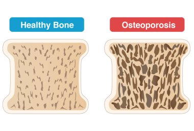 Osteoporotik ve normal kemiklerin kesitsel görüntülerinin karşılaştırılması