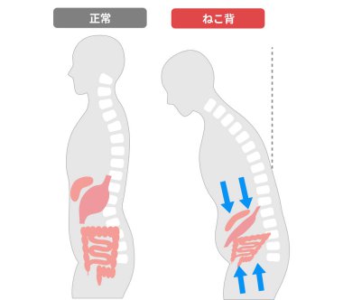 İç organları Yuvarlak Omuzlar 'ın neden olduğu kötü duruş yüzünden sıkışan insanlarla karşılaştırma. Japonca