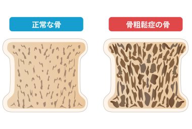 Comparison of cross-sectional views of osteoporotic and normal bone. Japanese language clipart