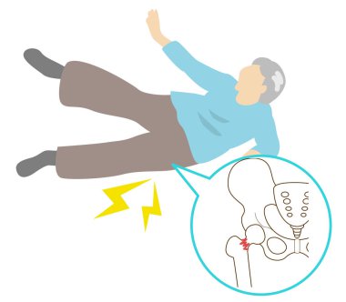 Osteoporoz nedeniyle yaşlılarda düşme kırıkları tercih ediliyor. Ayağın tabanında kırık var.