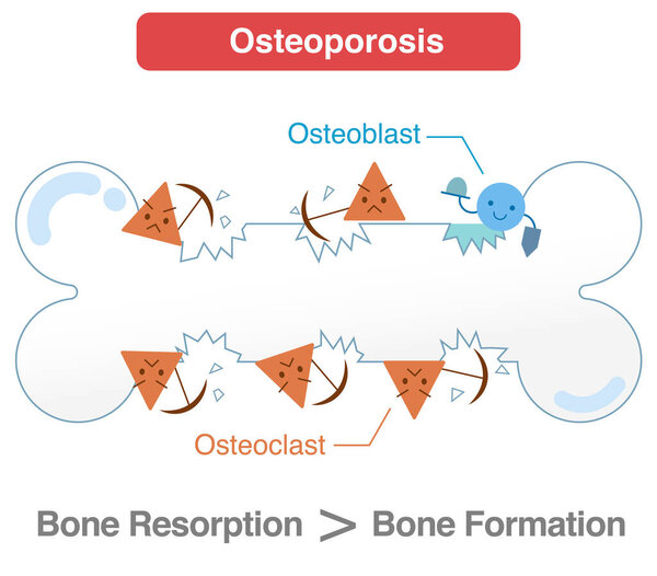 Остеопороз, вызванный дисбалансом между остеокластами и остеобластами. Цикл восстановления костей