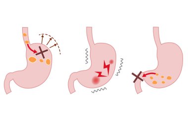 Fonksiyonel dispepsinin semptomlarını ve mekanizmalarını açıklayan illüstrasyon (FD)