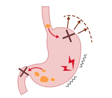 Fonksiyonel dispepsinin semptomlarını ve mekanizmalarını açıklayan illüstrasyon (FD)