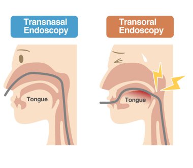 Transgenal ve transoral endoskopi (gastroskopi) arasındaki farkı açıklayan resim)