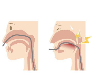 Transgenal ve transoral endoskopi (gastroskopi) arasındaki farkı açıklayan resim)