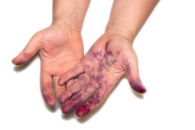 Fotoğraf dut suyu lekeleriyle elleri gösteriyor. Lekeler koyu mor ve avuç içi ve parmaklarda bulunuyor. Eller beyaz arka planda..