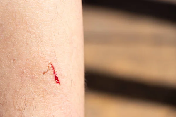 Kadın Bacağında Kanama Yaralanma Var — Stok fotoğraf