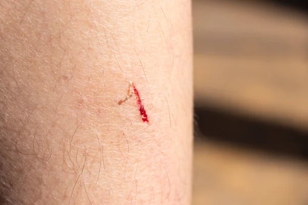 Τραυματισμός Από Μελανιασμένο Τραύμα Αιμορραγία Στο Γυναικείο Πόδι — Φωτογραφία Αρχείου