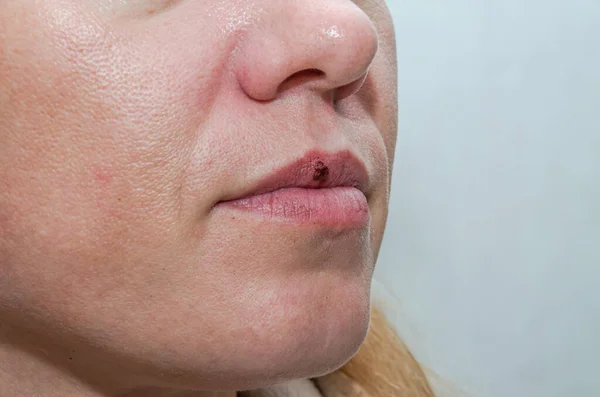 女人嘴唇上的带血疱疹 — 图库照片