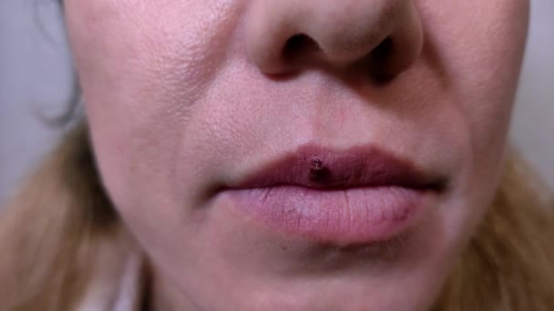 Krwawa Opryszczka Ustach Kobiety — Wideo stockowe