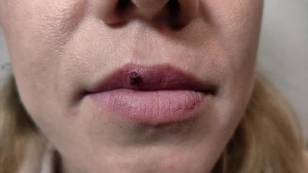 Bloederige Herpes Wond Vrouwelijke Lippen — Stockvideo