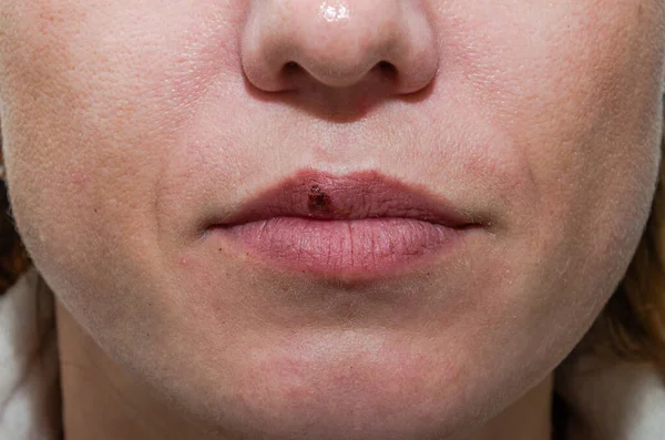 Bloederige Herpes Wond Vrouwelijke Lippen — Stockfoto