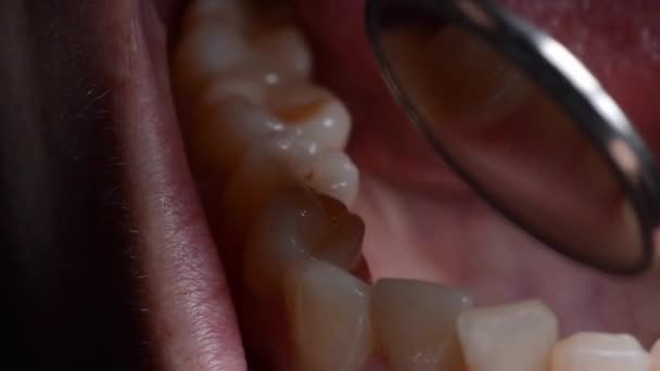 Dentysta Leczy Zęby Pacjentowi — Wideo stockowe