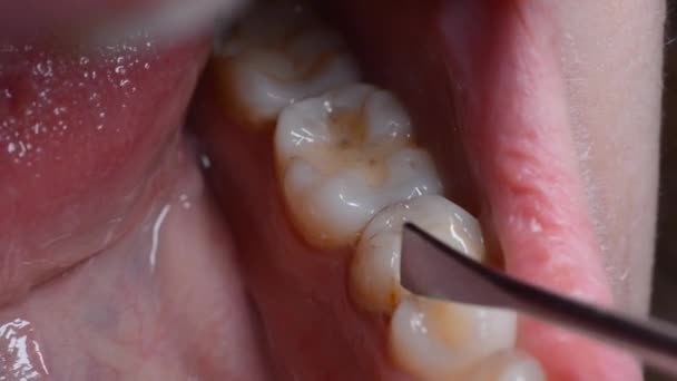 Dentista Tratta Denti Paziente — Video Stock
