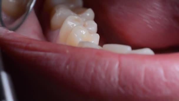 Dentista Tratta Denti Paziente — Video Stock