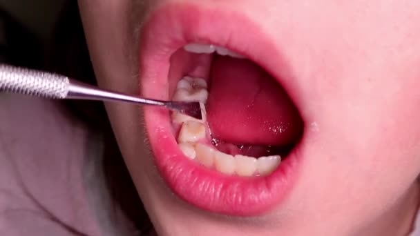 Dentysta Dziecięcy Bada Dziecka Luźny Ząb Mleczny — Wideo stockowe