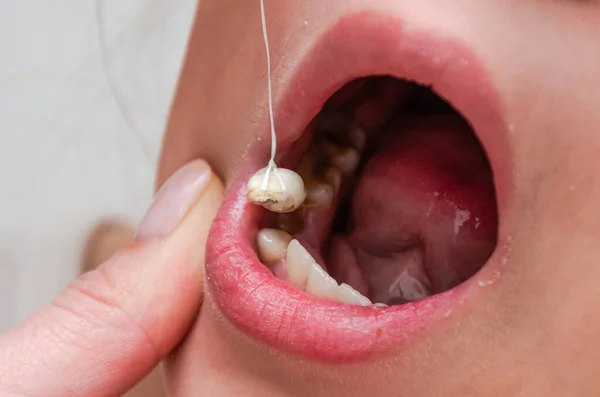 赤ん坊の乳の歯は糸で抜かれてる — ストック写真