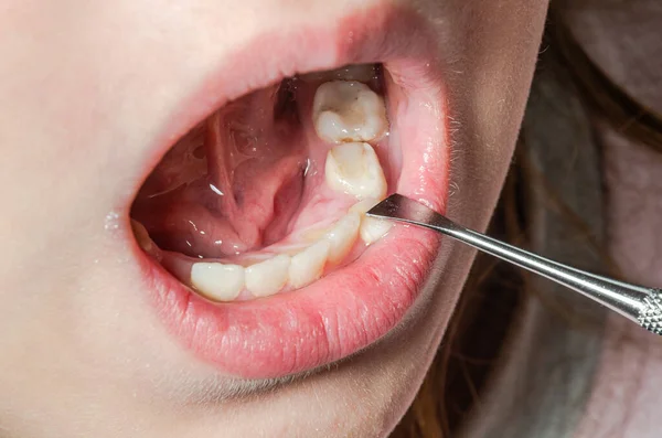 儿科牙医检查小孩松动的乳牙 — 图库照片