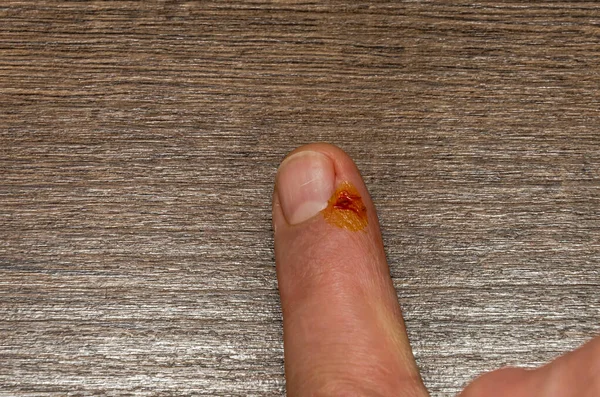 Dedos Cortados Lesionados Mano —  Fotos de Stock
