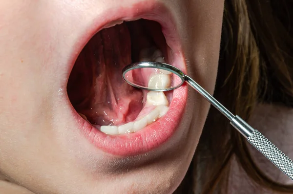 小児科の歯科医は 子供の中の緩いミルク歯を調べる — ストック写真