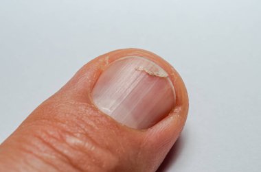 Bir adamın parmağında kırık tırnak.