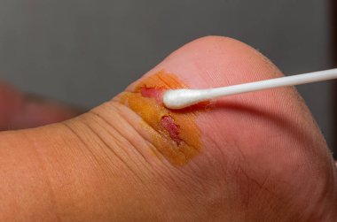 Doktor ilk yardım sağlar, bir yarayı tedavi eder - bir çocuğun ayağında nasır.