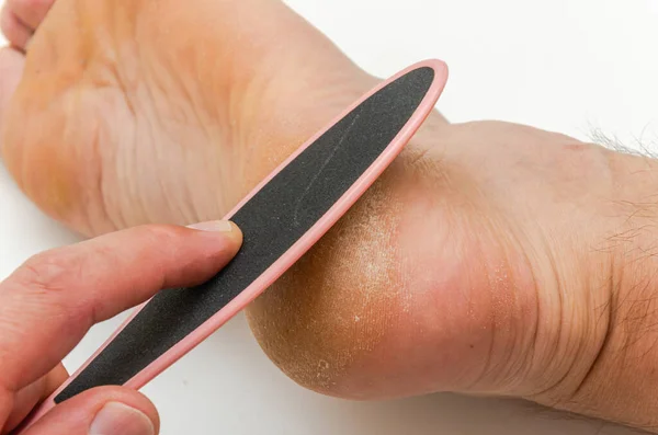 Pedicure file does a pedicure on a cracked heel