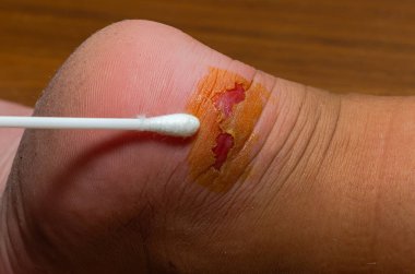 Doktor ilk yardım sağlar, bir yarayı tedavi eder - bir çocuğun ayağında nasır.