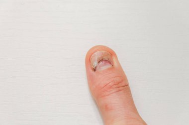 Injured damaged fingernail on white background clipart