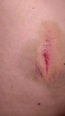 Bir insanın karnında çürük ve kurumuş kan travması.