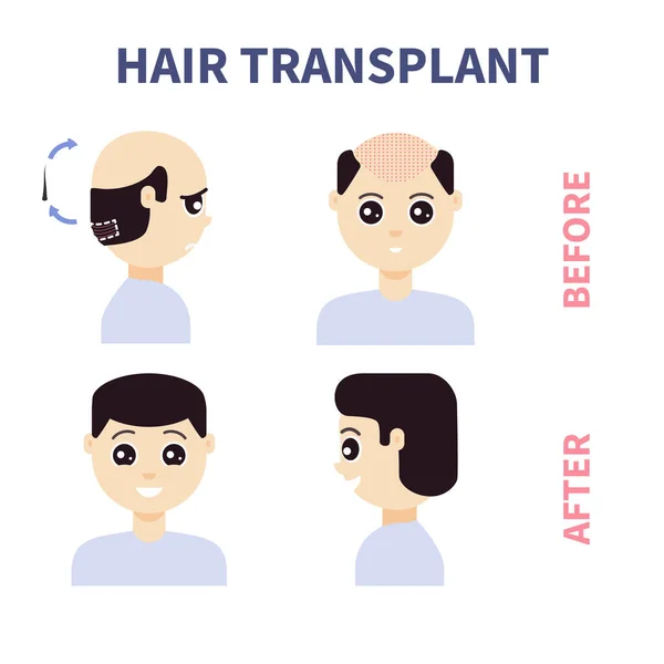Fue Transplantace Vlasů Léčba Alopecie Přední Boční Pohled Muže Před — Stockový vektor