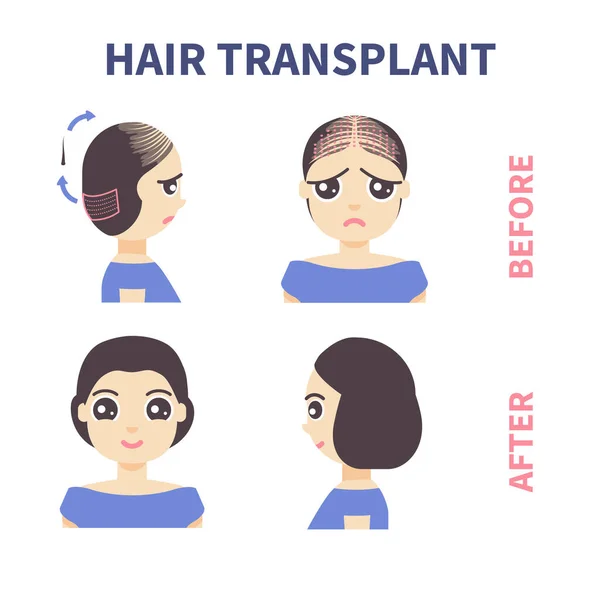 Fue Лікування Трансплантації Волосся Алопеції Передній Бічний Погляд Жінку Після — стоковий вектор