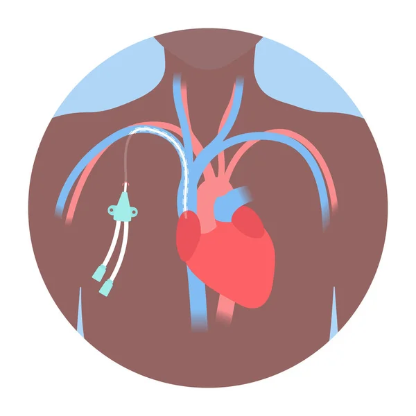 导管中心静脉导管放置在锁骨下静脉中 Cvc患者长期化疗输注和血液取样 中线管关闭 矢量说明 — 图库矢量图片