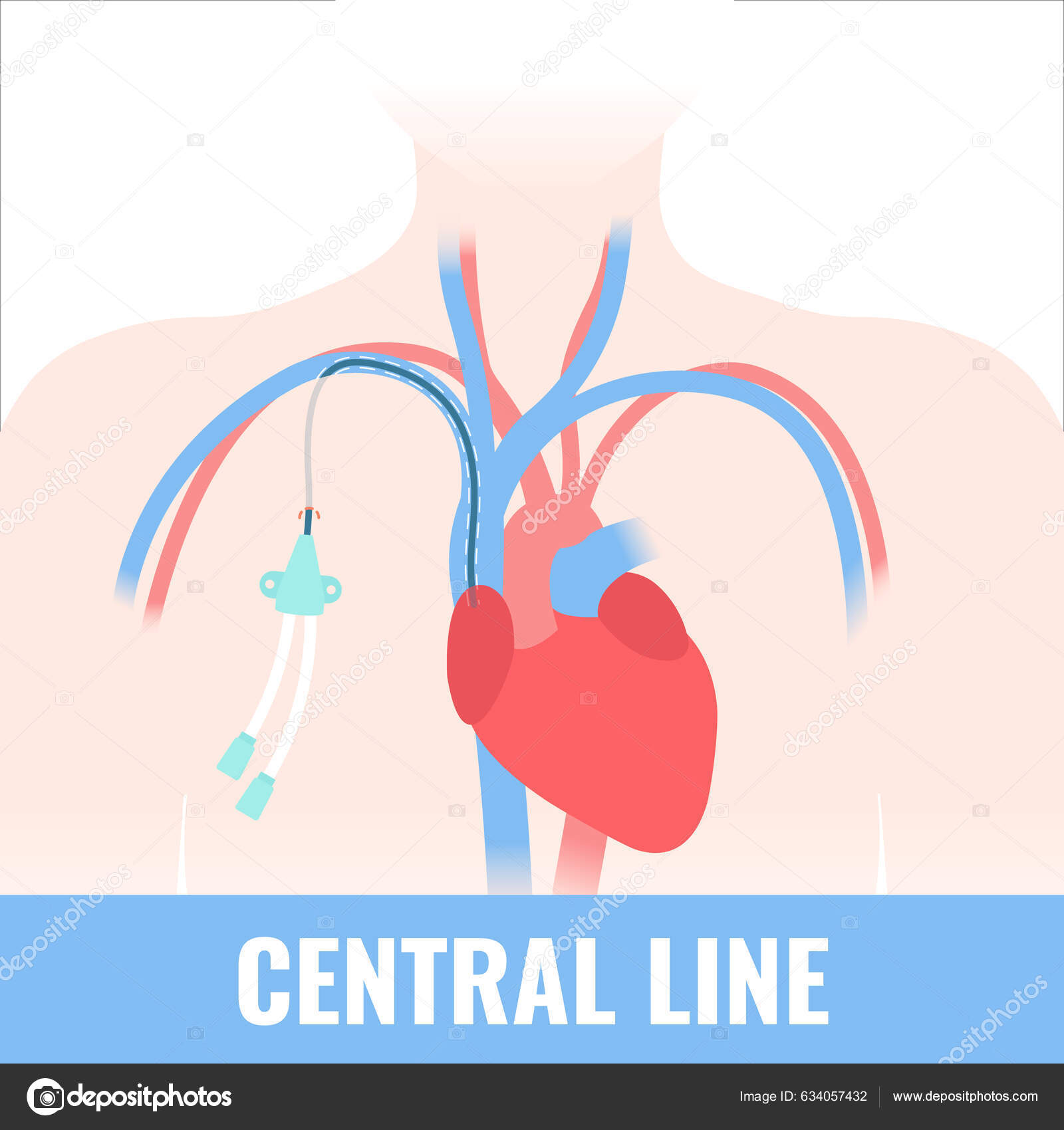 Tunneled Central Venous Catheter Placed Subclavian Vein Patient Cvc ...