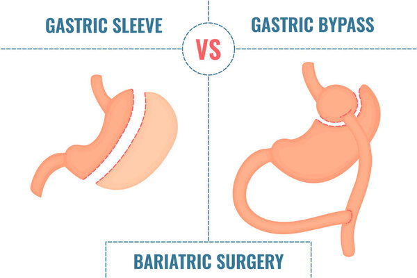 Gastric sleeve vs gastric bypass. Bariatric surgery weight loss procedures comparison. Stomach reduction anatomical diagram infographics. Health care medical concept. Vector illustration.