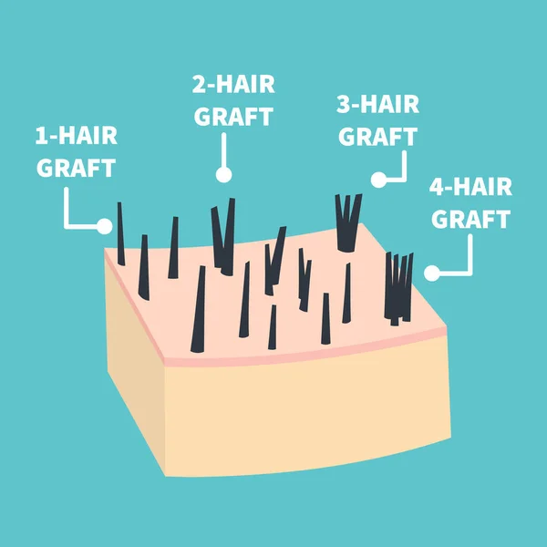 毛髪移植手術用の毛髪マイクログラフト分類セット 毛包単位または家族の毛の数を持つ皮膚断面 毛髪科学と解剖学 漫画ベクトルイラスト — ストックベクタ