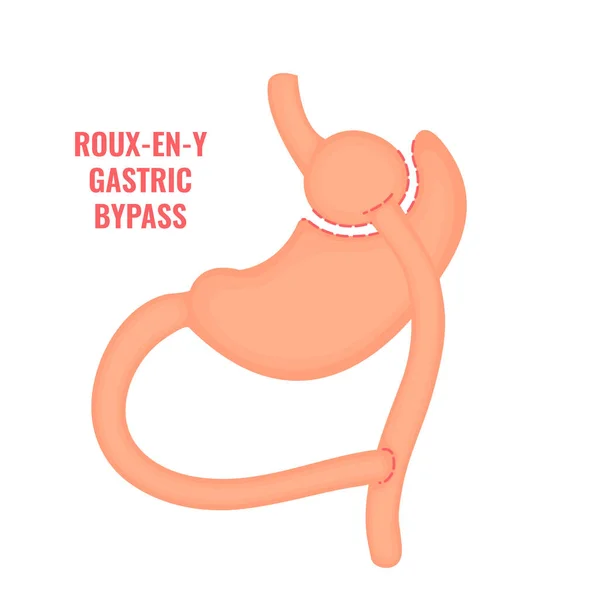 Roux Gastric Bypass Bariatric Surgery Weight Loss Procedure Stomach Reduction — Vetor de Stock