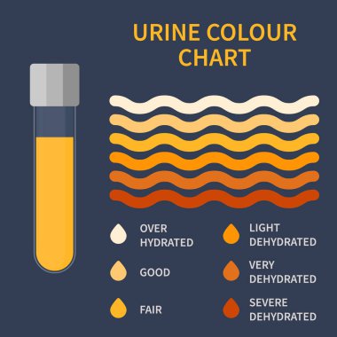 Urine colour chart. Hydration and dehydration level diagram. Medical urinal test kit for urinary tract infection research. Containers with yellow to brown pee for urinalysis. Vector illustration. clipart