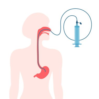 Nasogastric tube passed through the nose to stomach. NG with a syringe for feeding and administering medication. Health care and emergency medical concept. Vector illustration. clipart